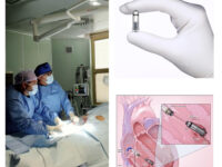 Ospedale Ascoli, impiantato pacemaker senza fili