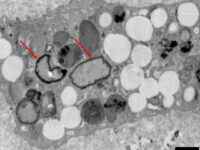 Studio individua microplastiche nelle placche aterosclerotiche umane